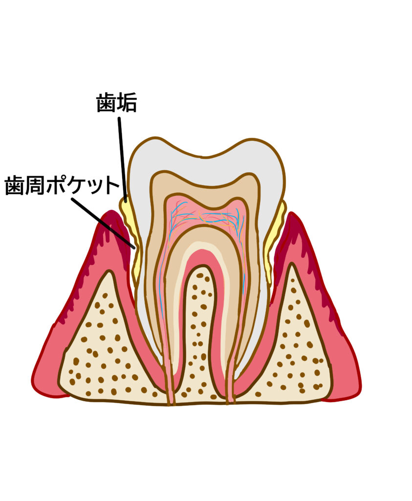 歯周ポケットと歯垢