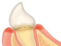 歯肉炎
