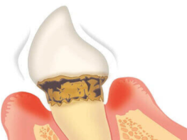 中等度歯周炎