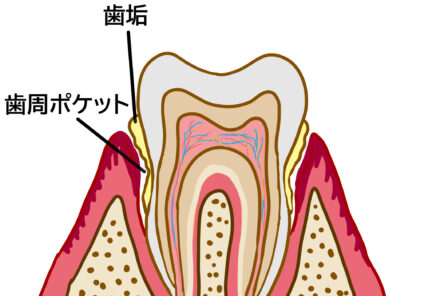 手遅れになる前に予防を