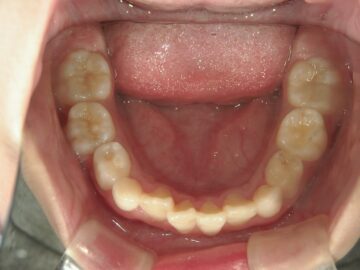 歯の症例写真