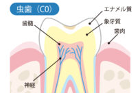 初期の虫歯