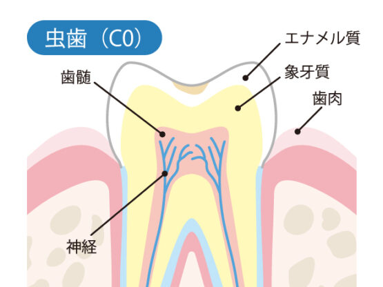 初期の虫歯