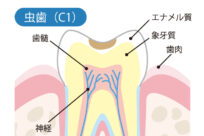 虫歯の始まり