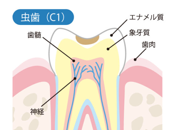 虫歯の始まり