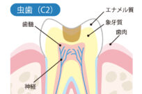 象牙質のむし歯