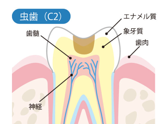 象牙質のむし歯