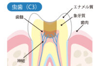 神経まで進んだ虫歯