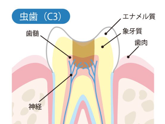 神経まで進んだ虫歯