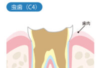 歯の根しか残ってない状態