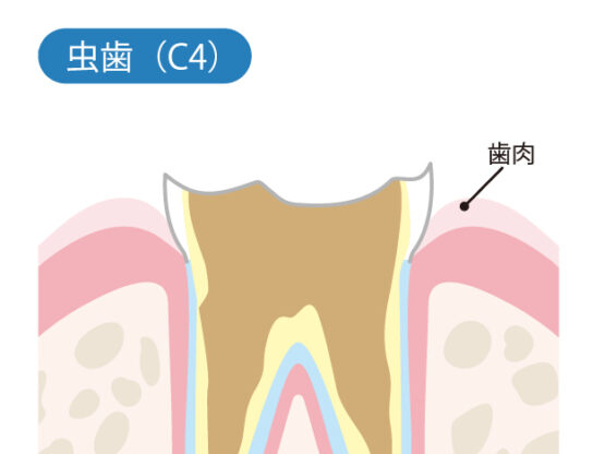 歯の根しか残ってない状態